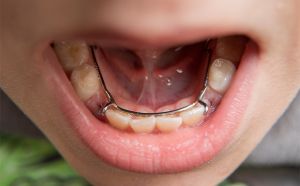 Early orthodontics in Durham & Oxford, NC - Wilson Orthodontics 8